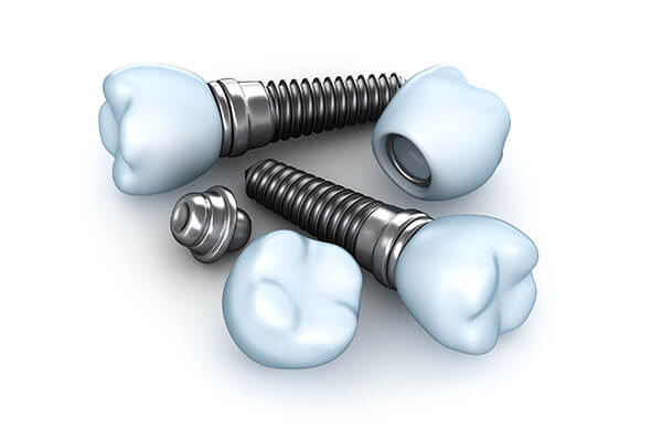 Dental Implants